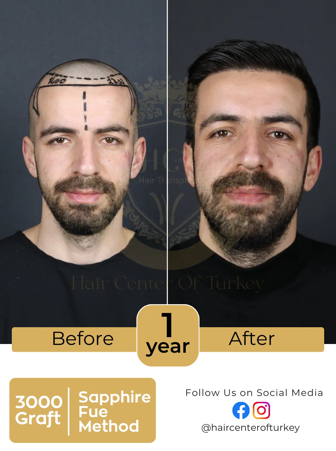 New Hair Transplant Before After