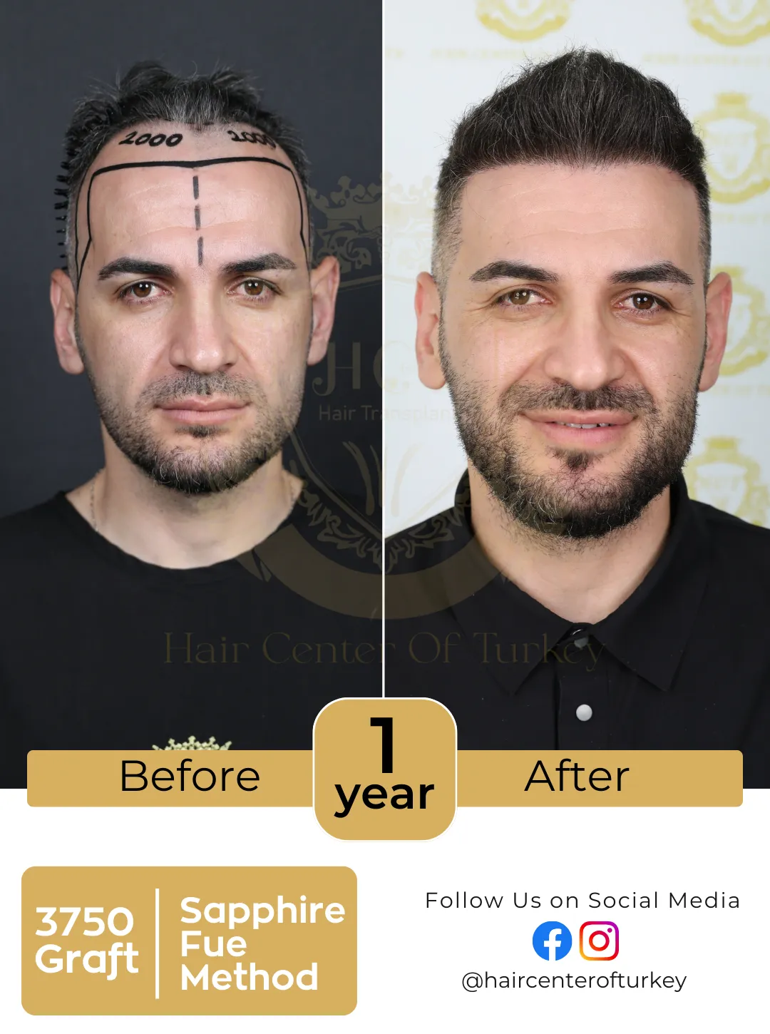 New Hair Transplant Before After