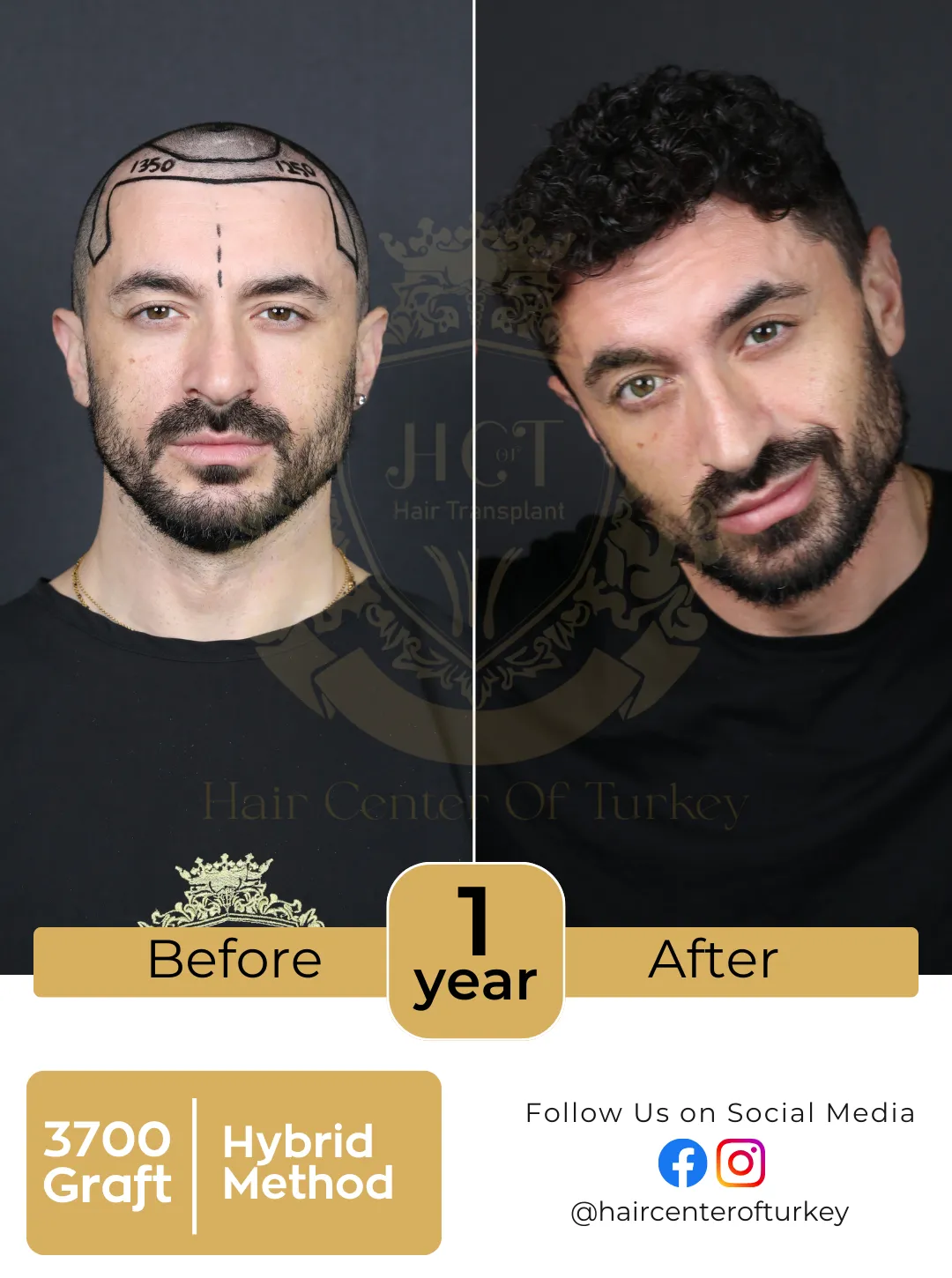 New Hair Transplant Before After