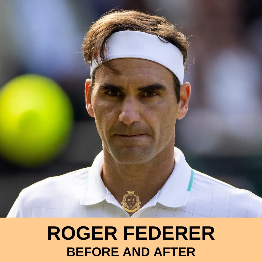 roger federer Hair Transplant