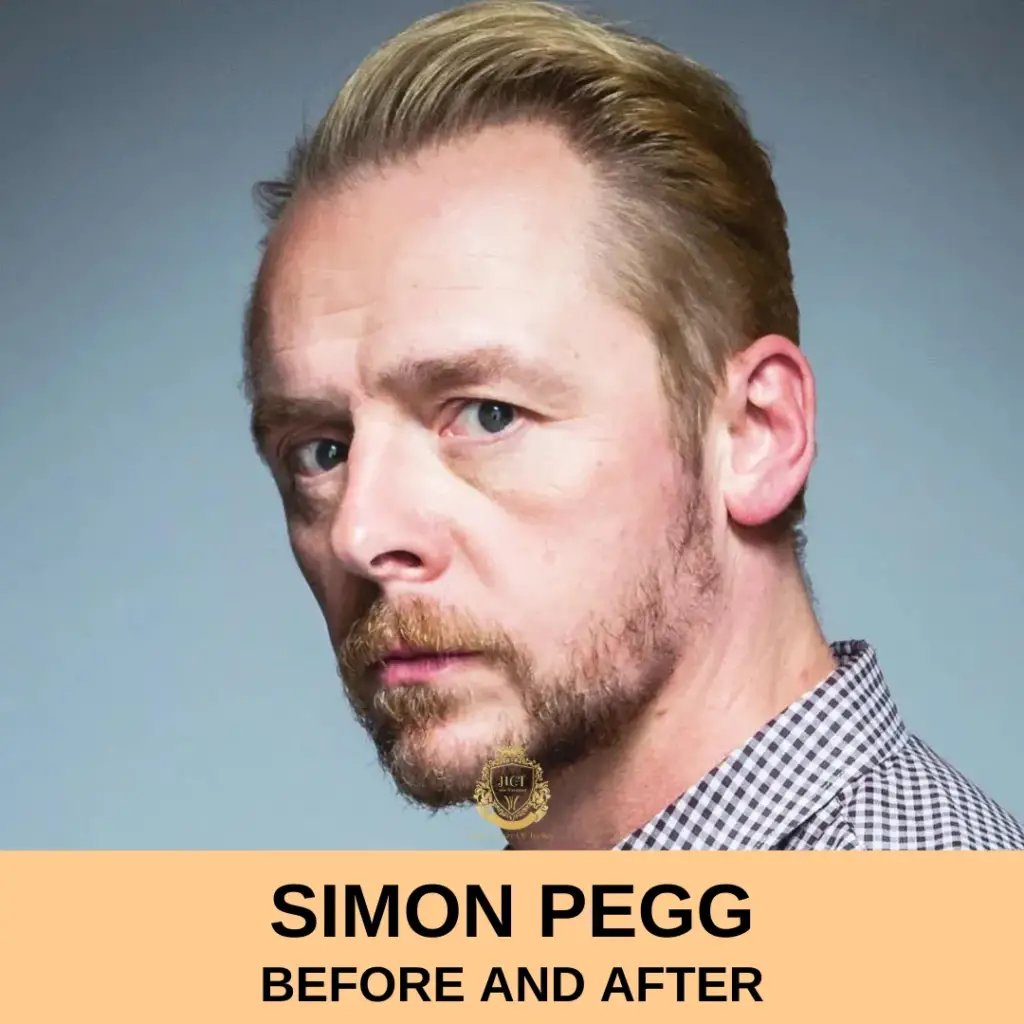 Simon Pegg Hair Transplant