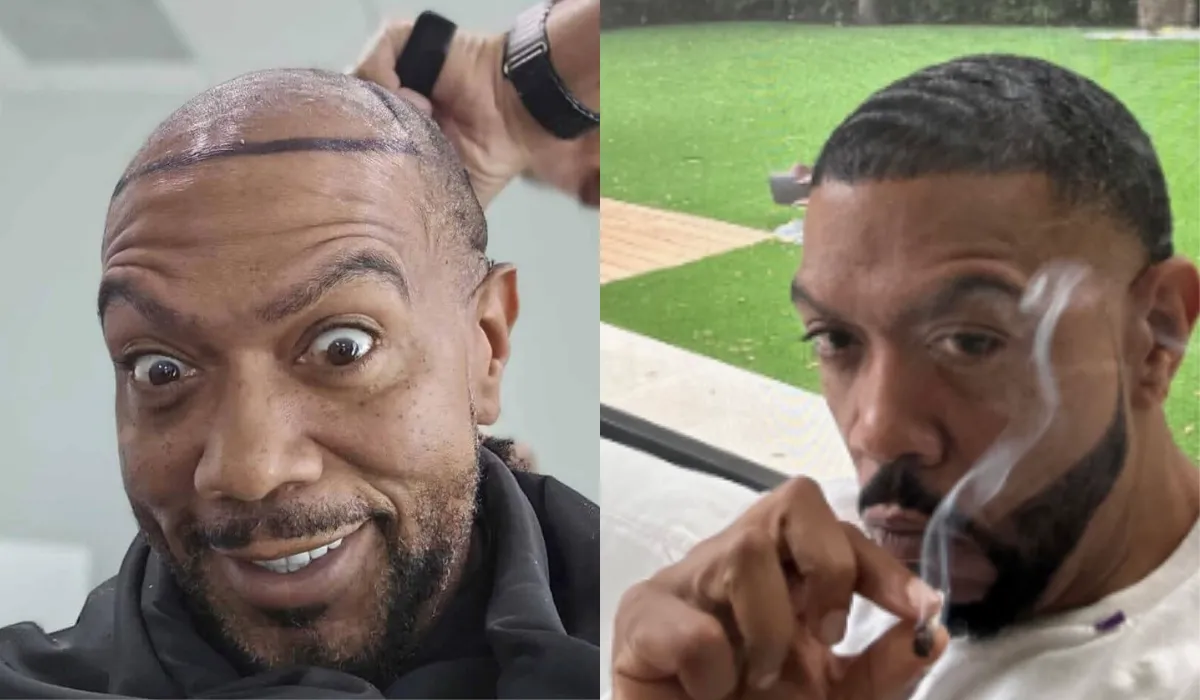 Timbaland Hair Transplant 