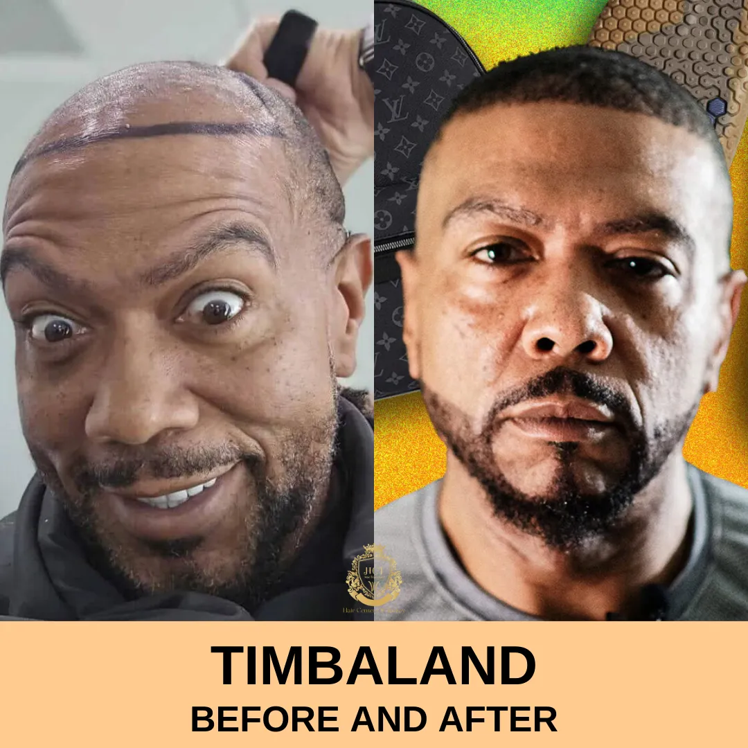 Timbaland Hair Transplant