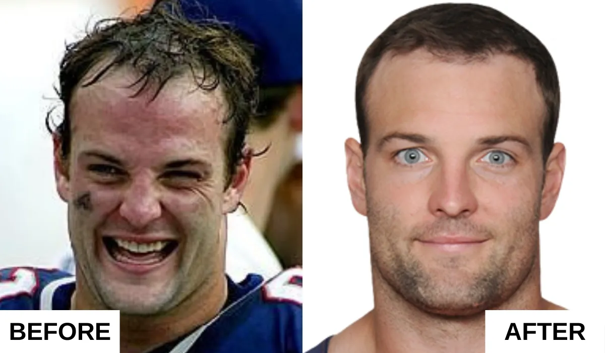 Wes Welker Hair Transplant