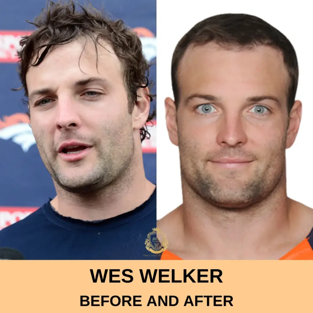 Wes Welker Hair Transplant