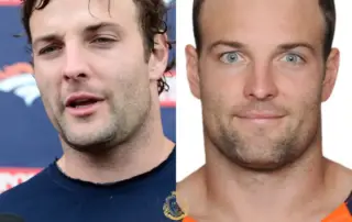 Wes Welker Hair Transplant