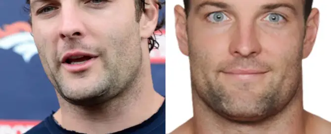 Wes Welker Hair Transplant