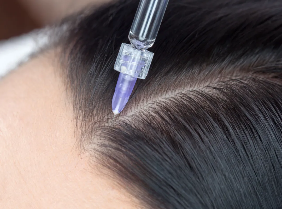 What is Hair Mesotherapy