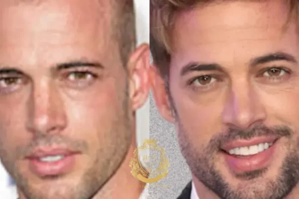 William Levy Haartransplantation