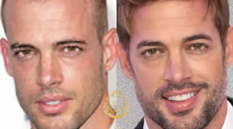 William Levy Hair Transplant