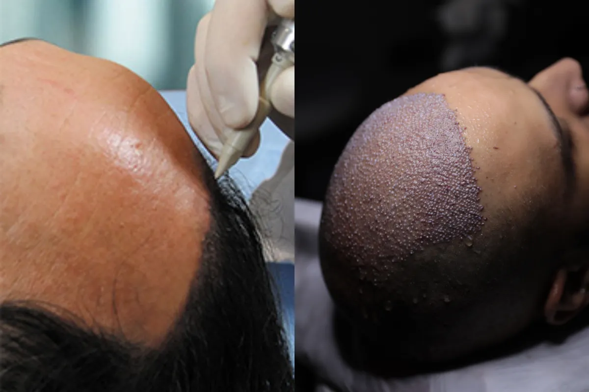 artificial hair transplant vs real hair transplant