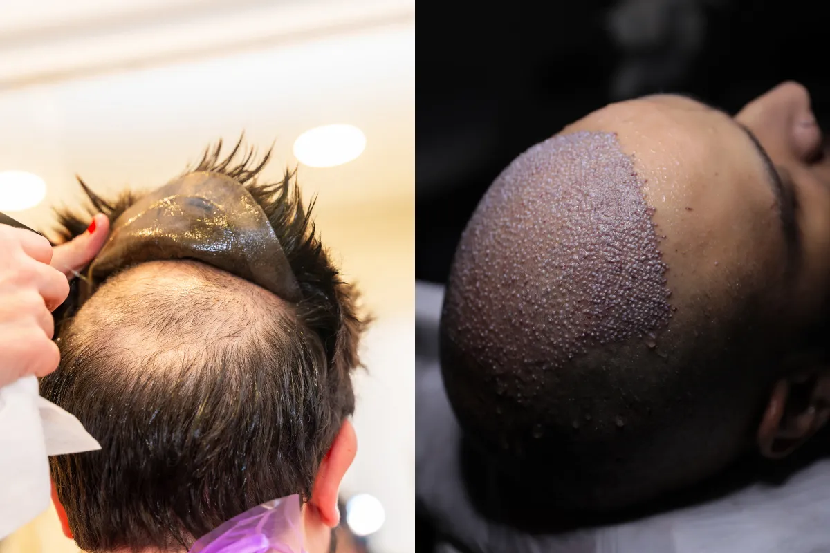 artificial vs real hair transplant