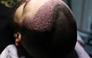 artificial vs real hair transplant