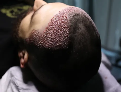 Künstliche Haartransplantation vs. Echte Haartransplantation