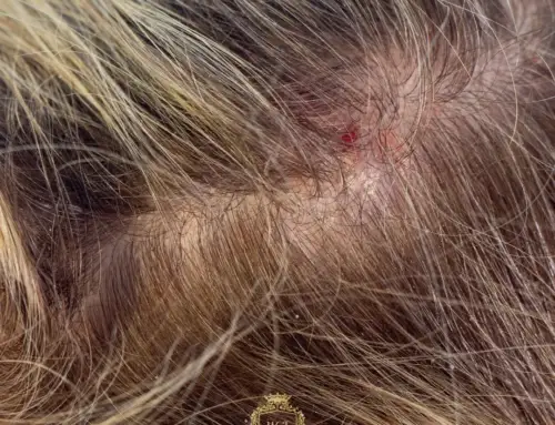 Ardor en el cuero cabelludo: causas, síntomas y tratamientos