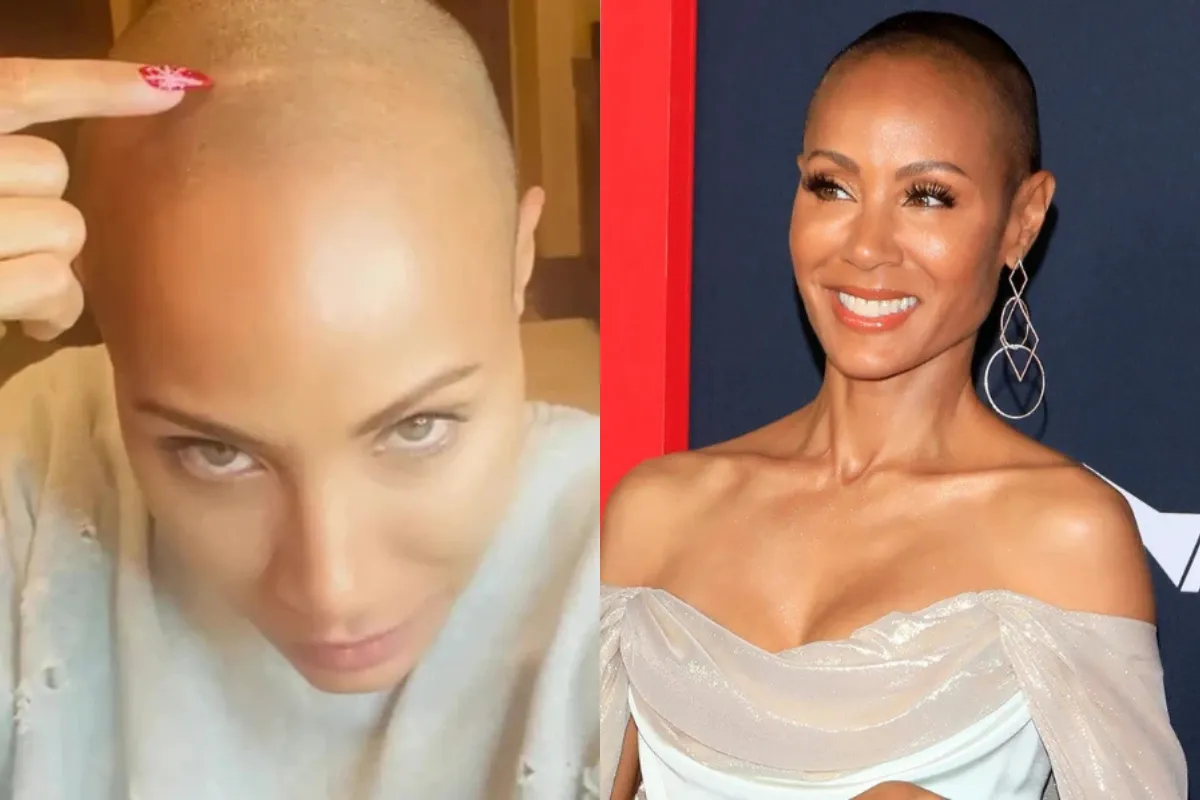 celebrities alopecia