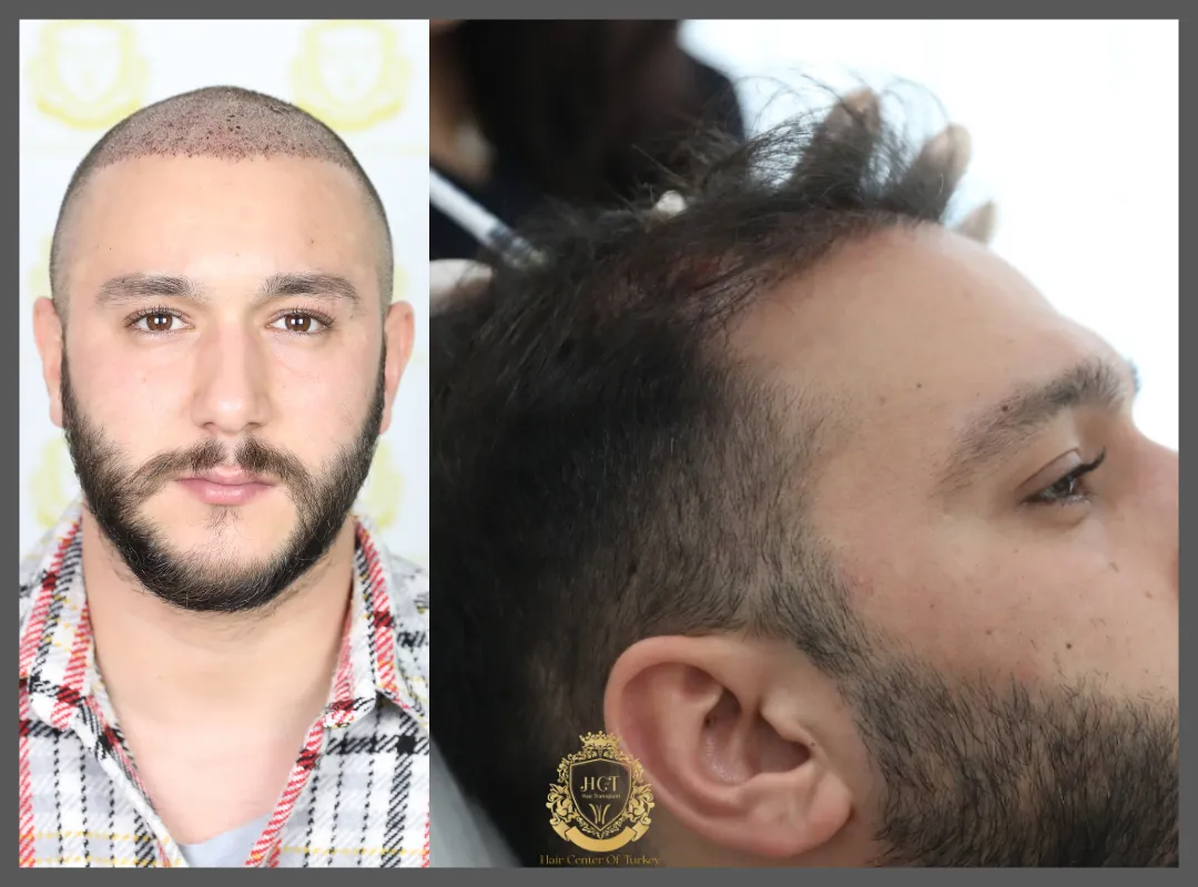 prp after hair transplant