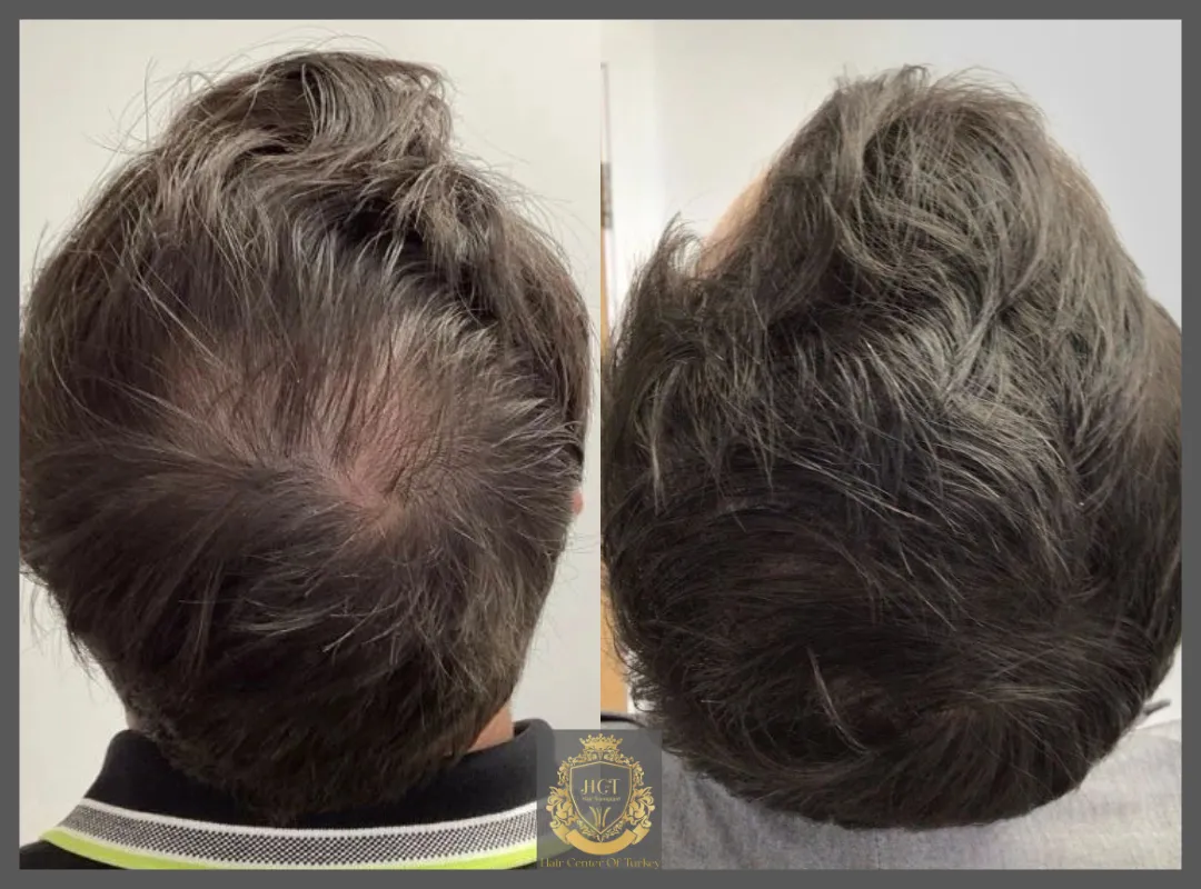 prp prevent hair