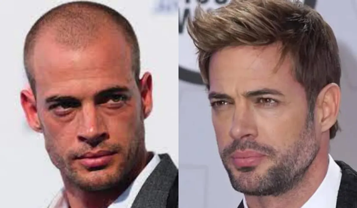 william levy Hair Transplant