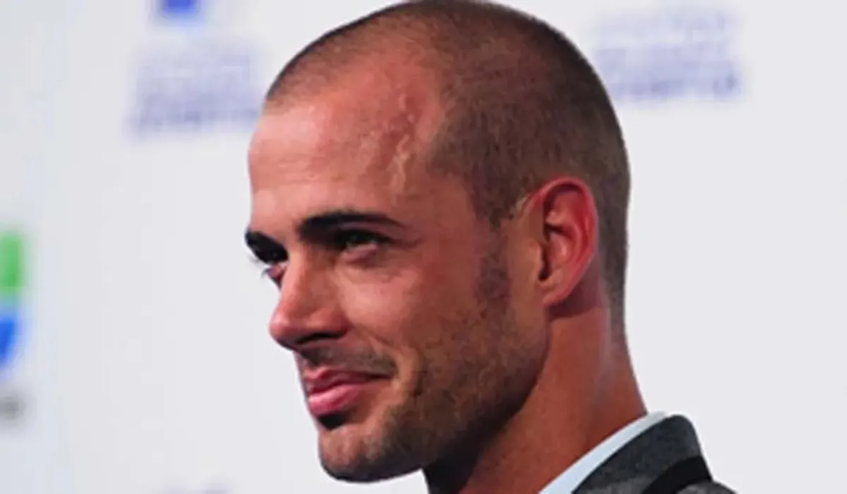 william levy Hair Transplant