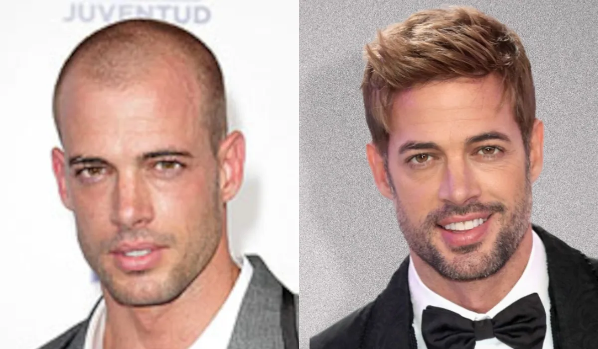 william levy Hair Transplant