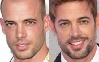 william levy Hair Transplant