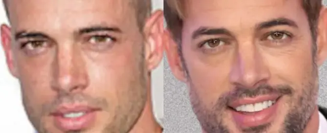 william levy Hair Transplant