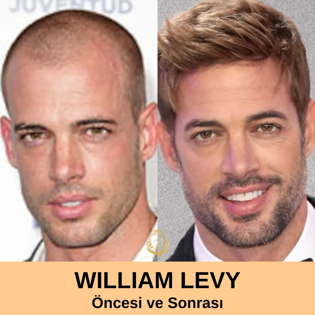 william levy saç ekimi