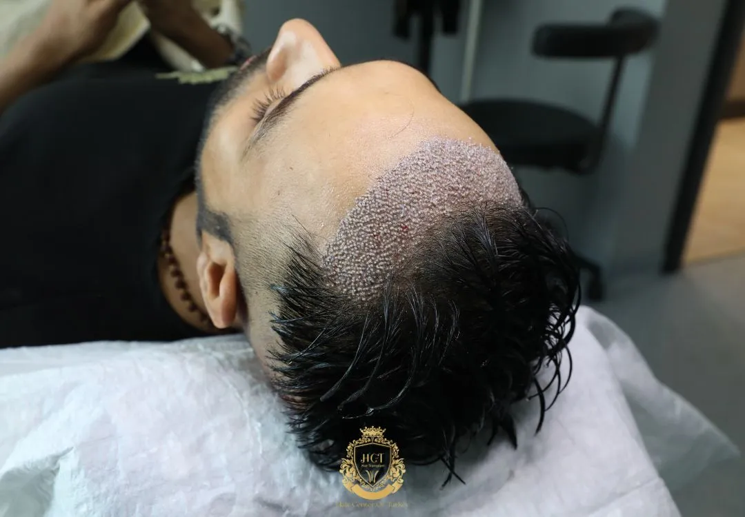 2500 graft hair transplant price