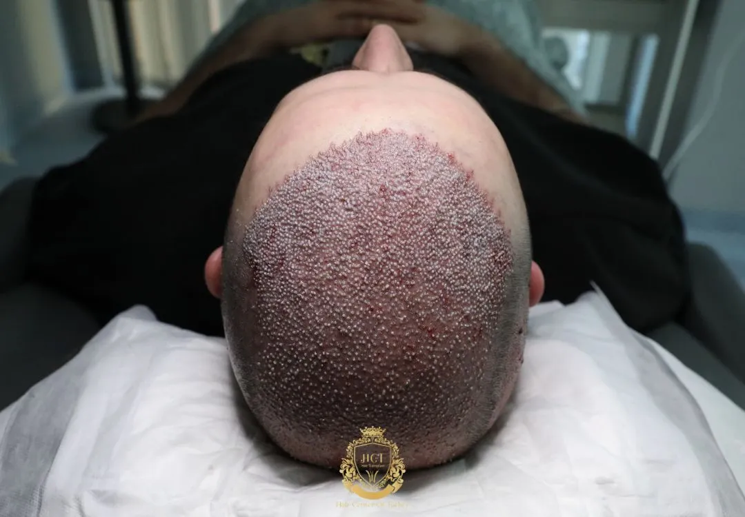 5500 graft hair transplant price