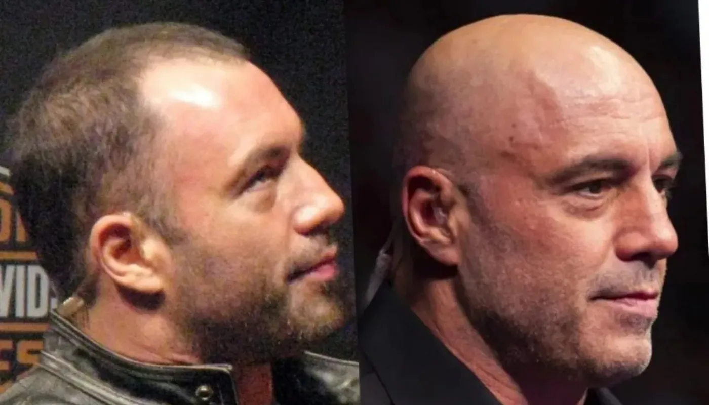 joe rogan hair transplant