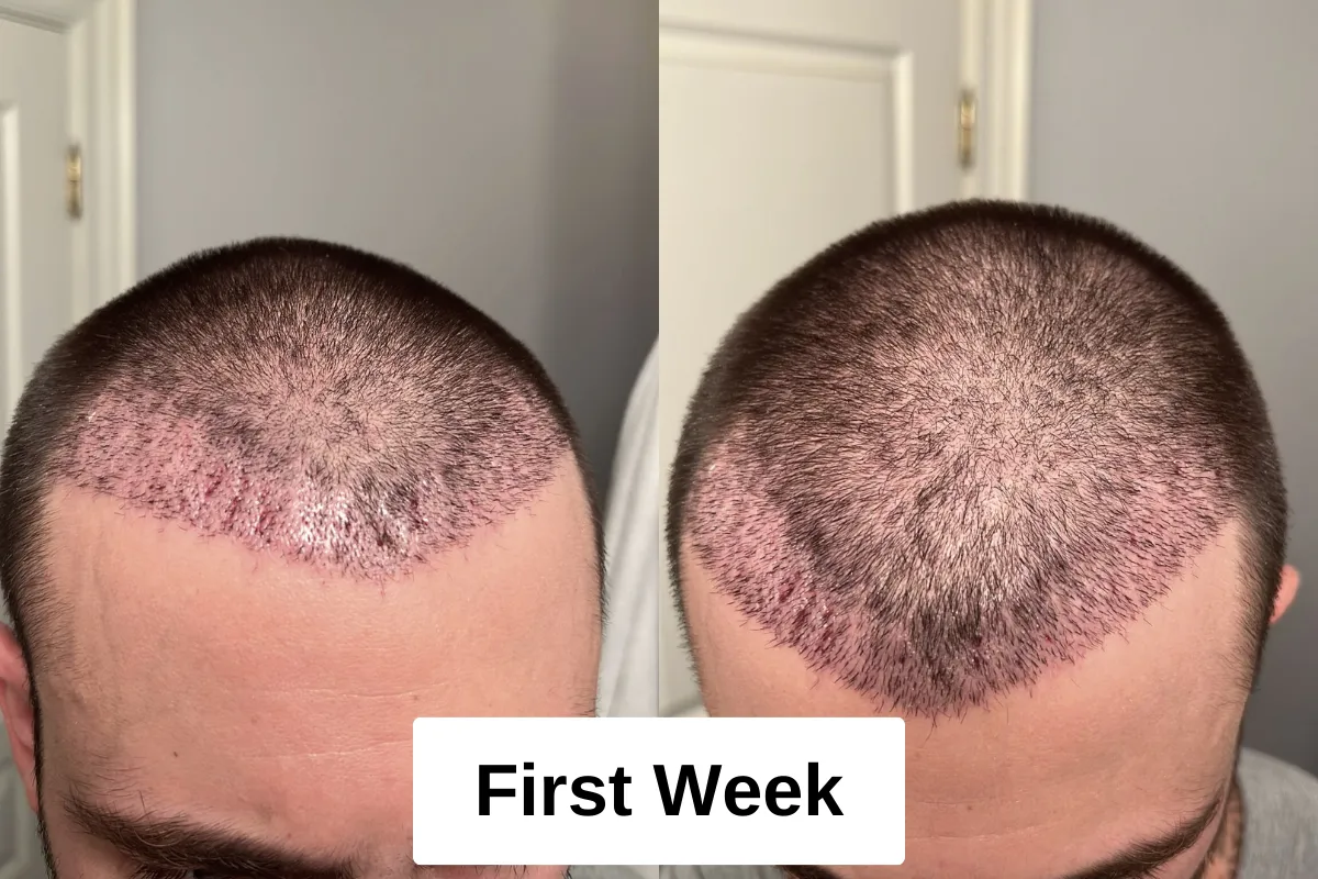 Crown hair transplant recovery