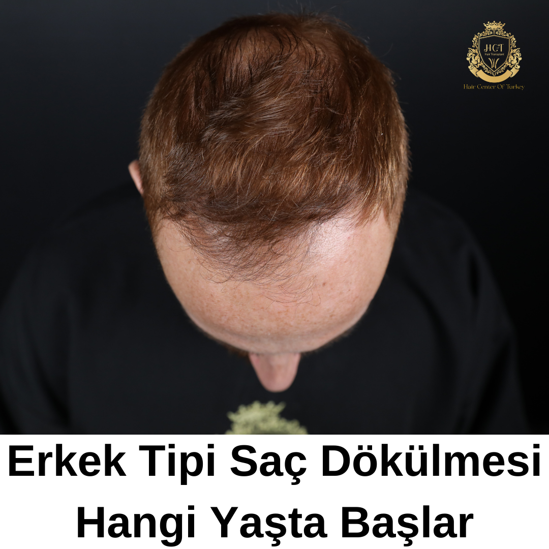 Erkek Tipi Saç Dökülmesi Hangi Yaşta Başlar