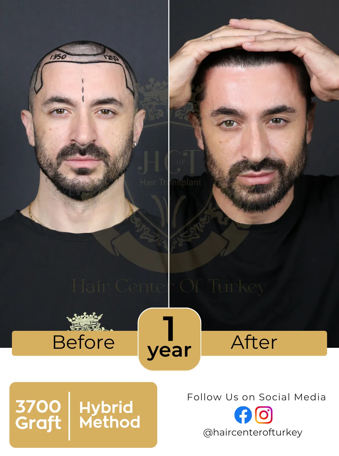 New Hair Transplant Before After