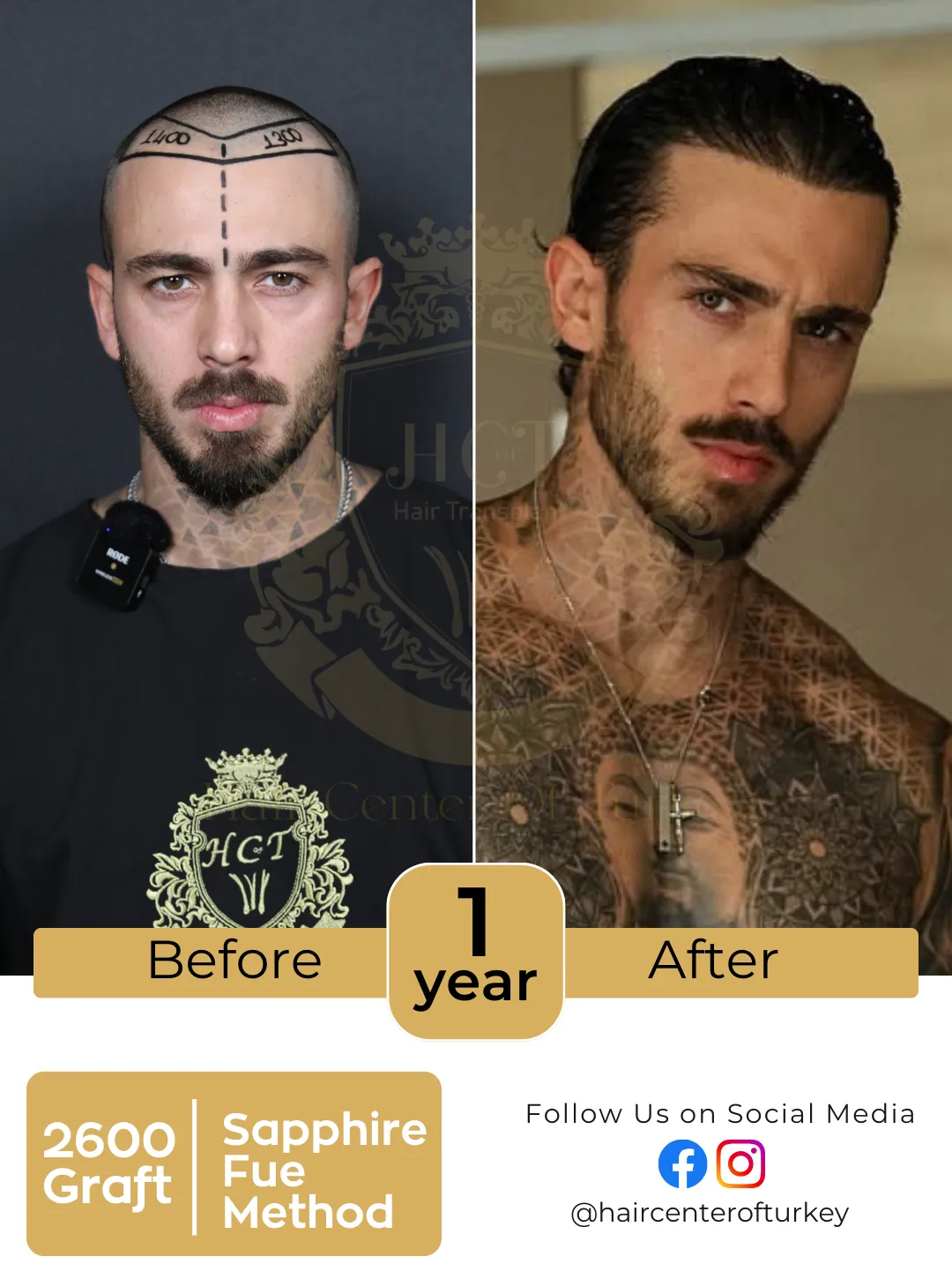 New Hair Transplant Before After