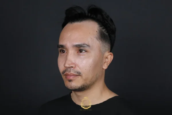 Vanaf welke leeftijd begint mannelijke kaalheid?