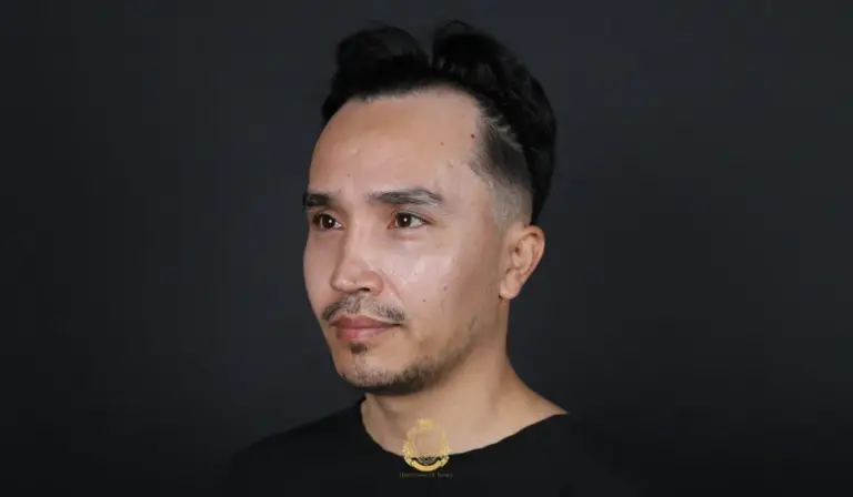 What Age Does Male Pattern Baldness Start?