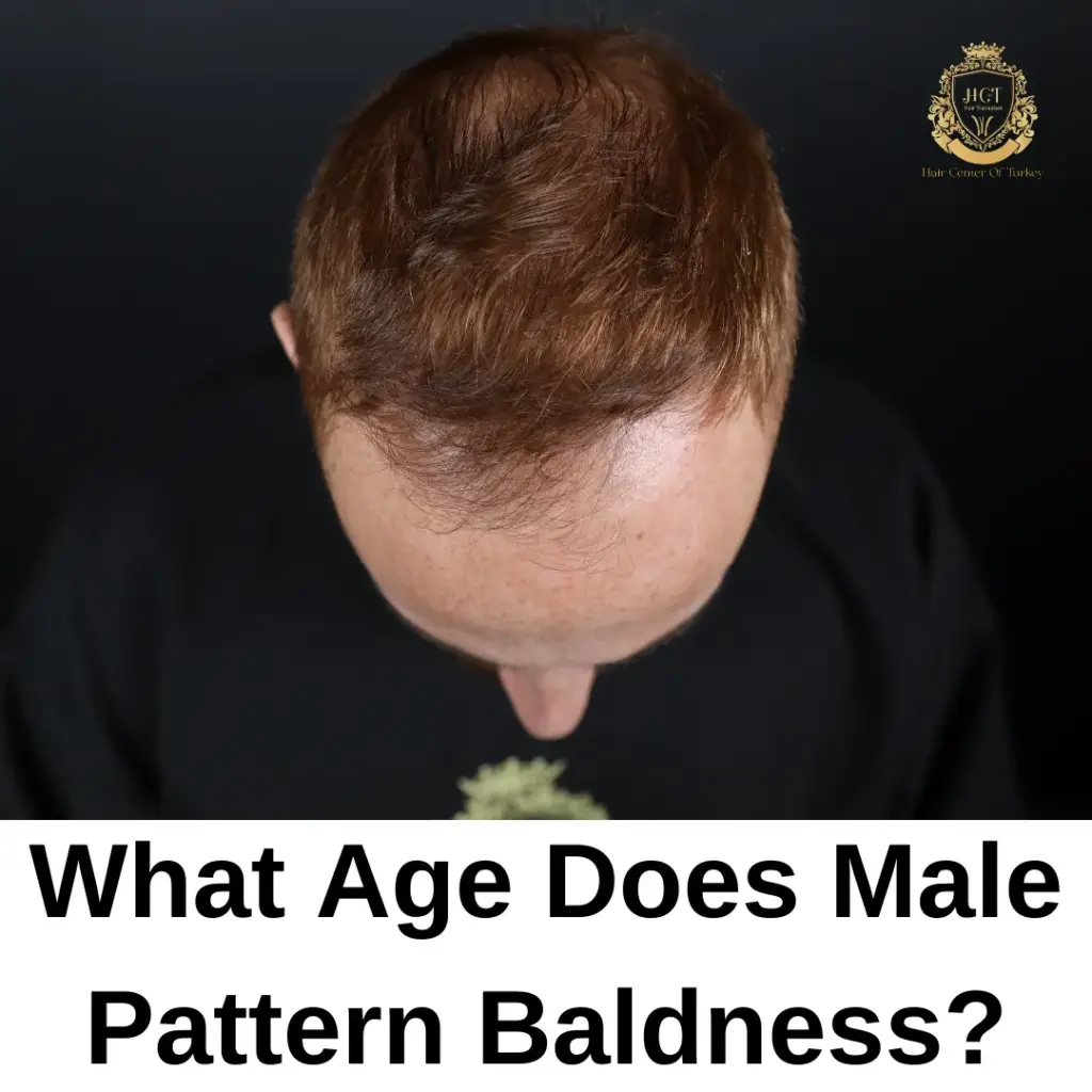 What Age Does Male Pattern Baldness