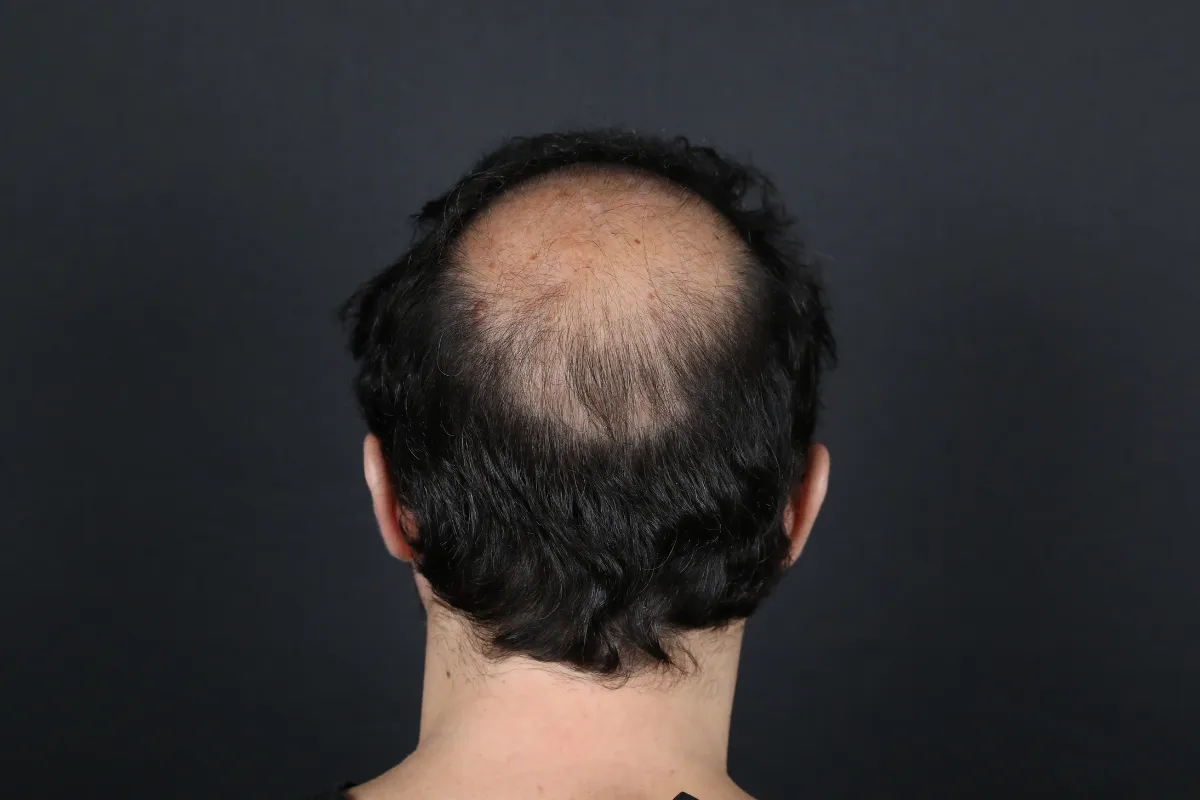 crown hair loss