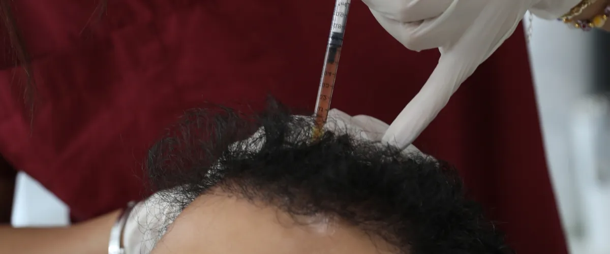 crown hair transplant