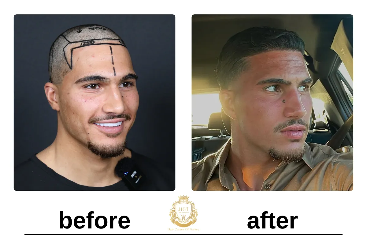 crown hair transplant