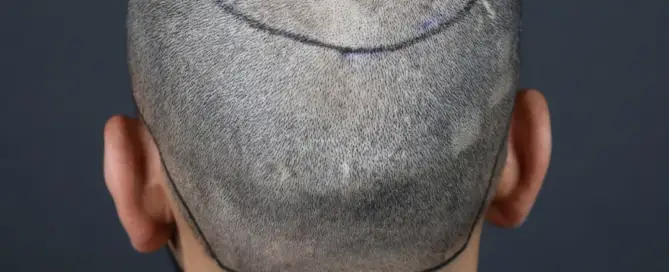 crown hair transplant