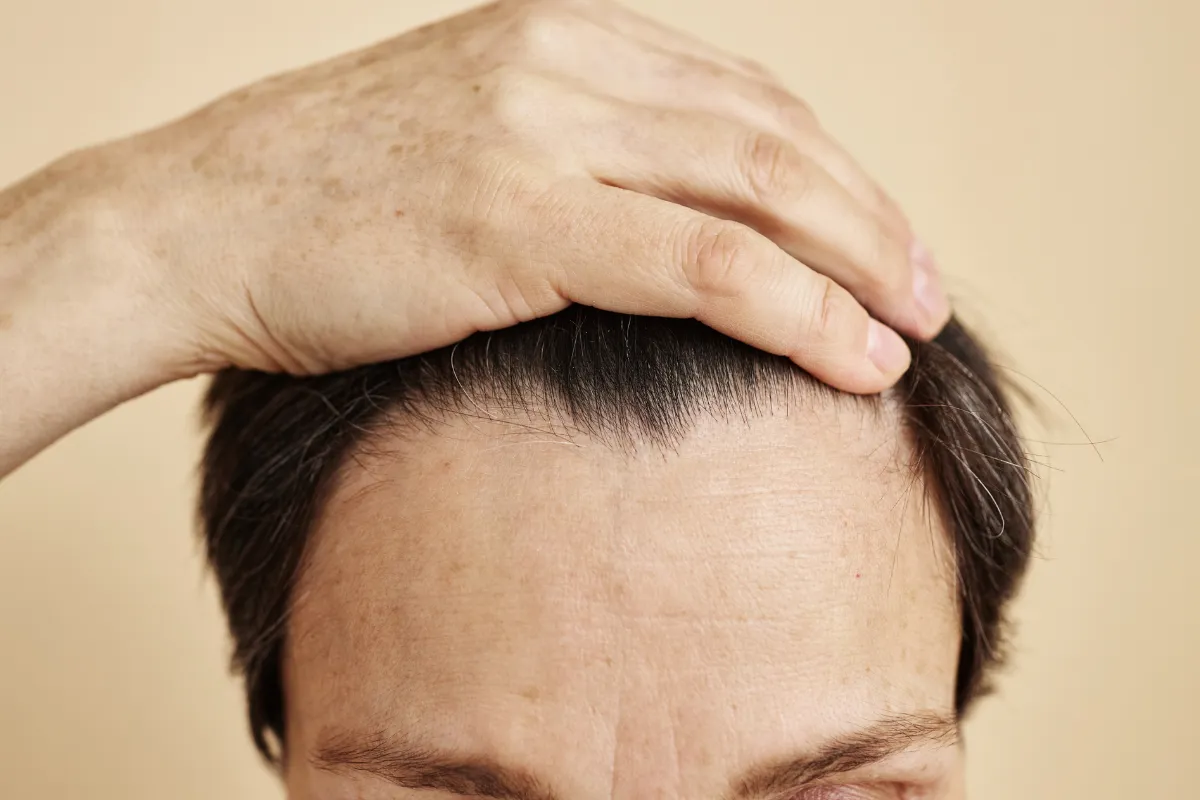 different hairline types