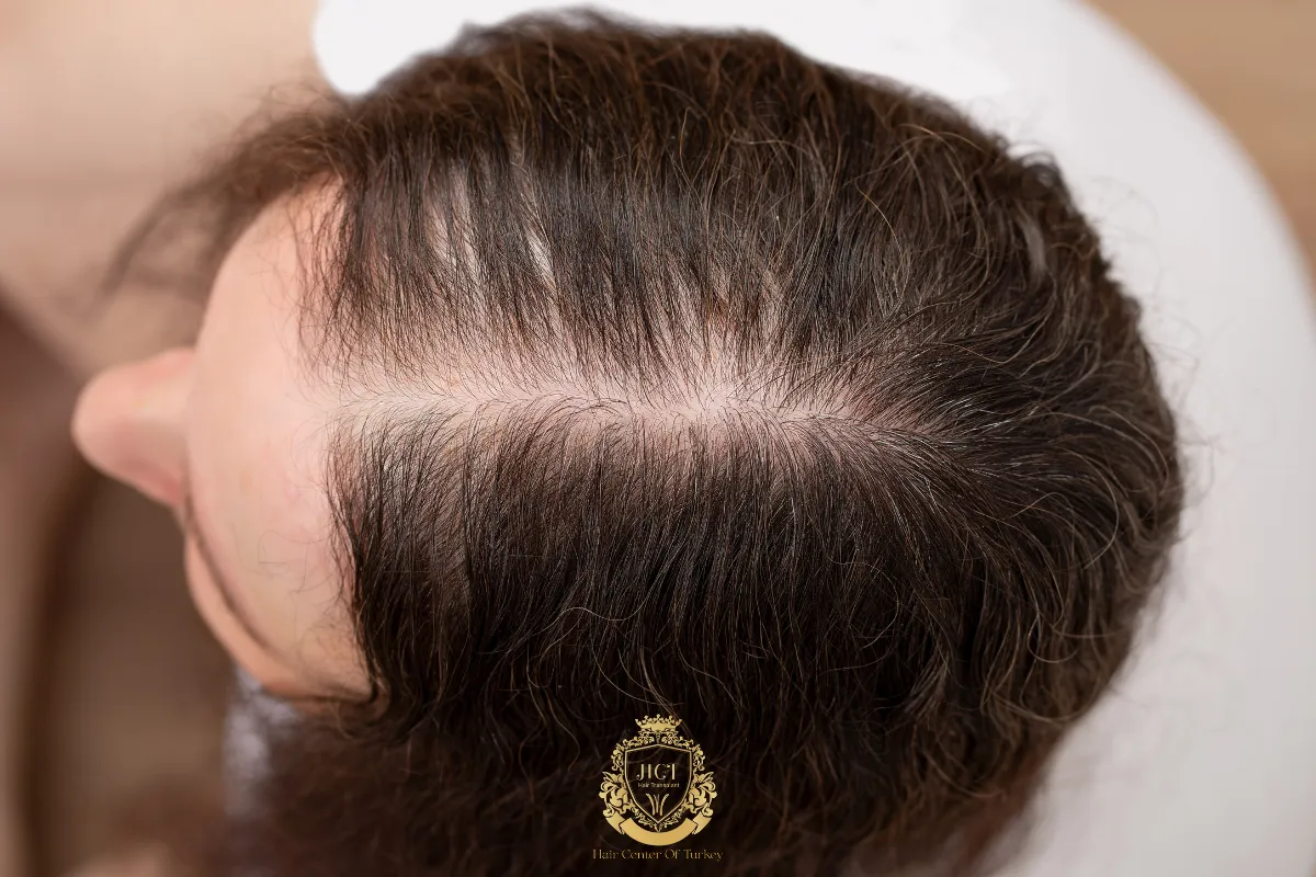 does low progesterone cause hair loss