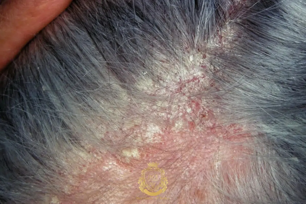 eczema and psoriasis hair loss