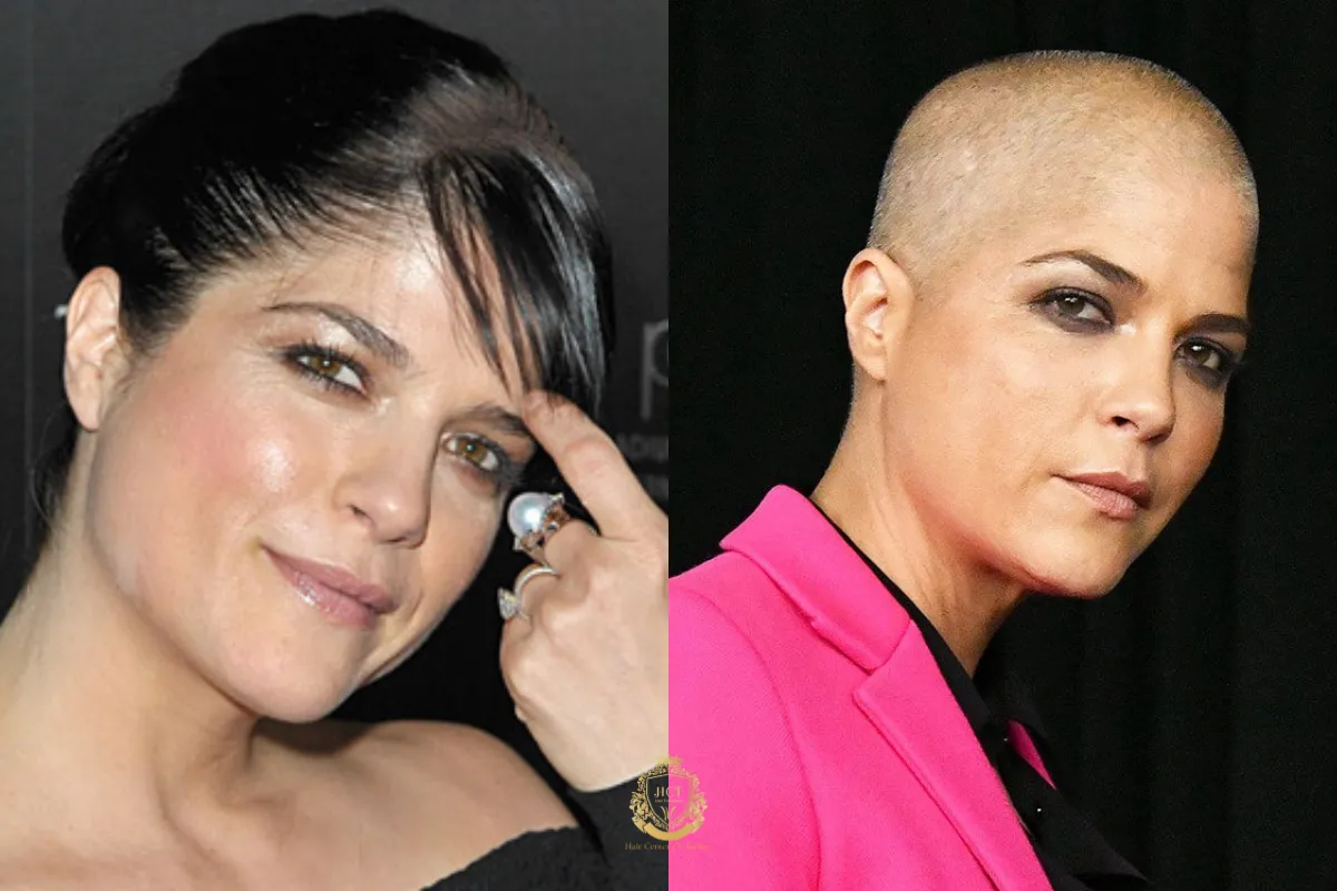 female celebrities hair loss