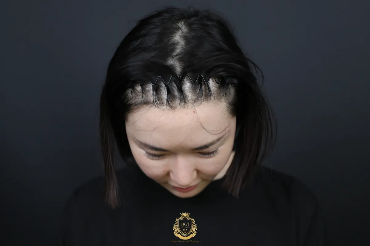 female pattern hair loss 20s