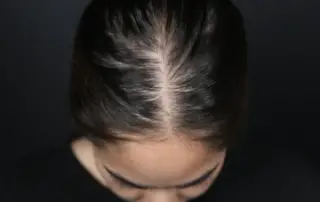 female pattern hair loss 20s