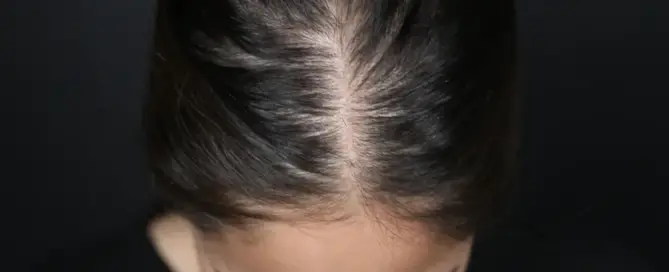 female pattern hair loss 20s