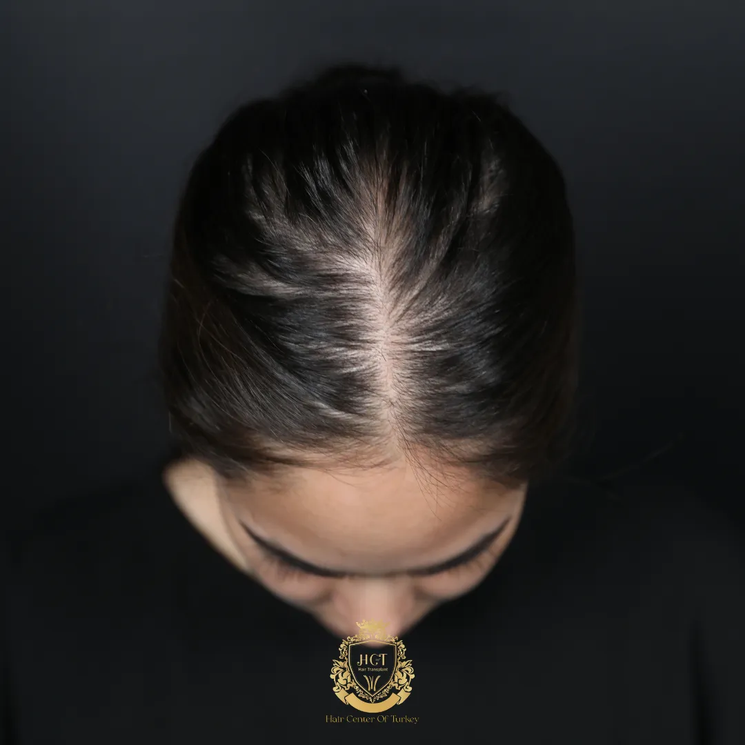 female pattern hair loss 20s